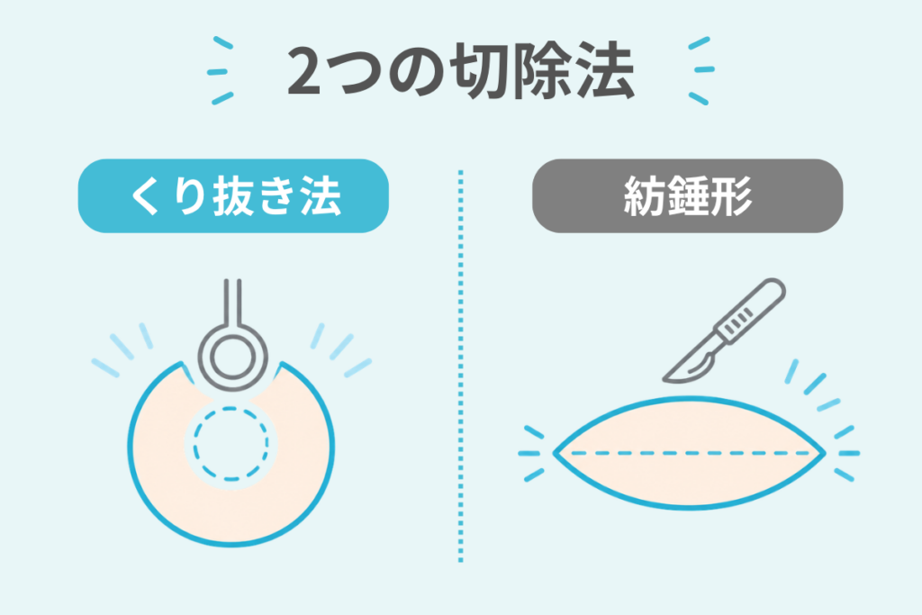 切除の方法（くり抜き法・紡錘形）