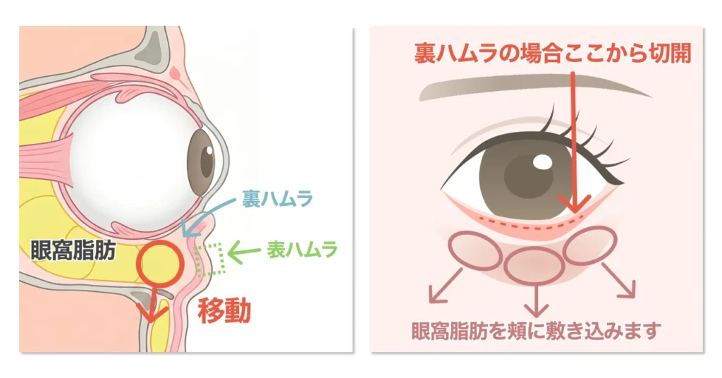 ハムラ法 (表ハムラと裏ハムラ)