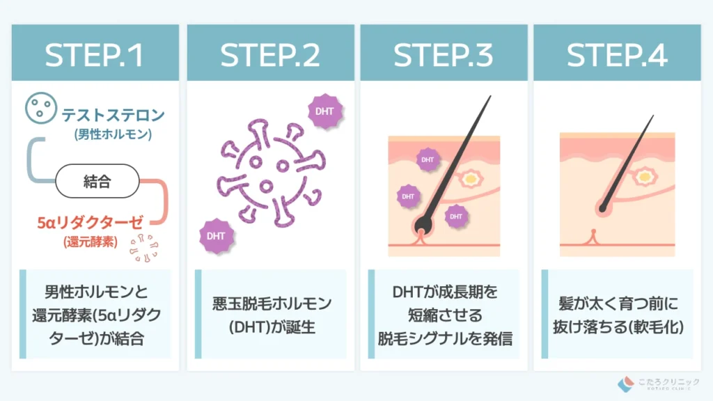 AGA (男性型脱毛症) が発症・進行する医学的な仕組み