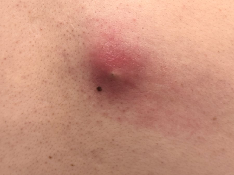 炎症を起こして赤く腫れた背中の粉瘤（アテローム）の写真