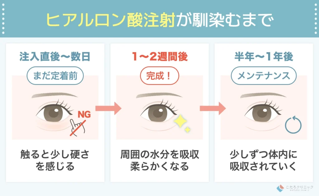 目の下のヒアルロン酸注射が馴染むまでの期間と持続期間
