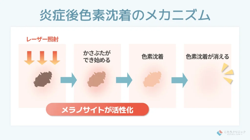 炎症後色素沈着が起こるメカニズム